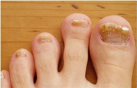 Brittle Toenails